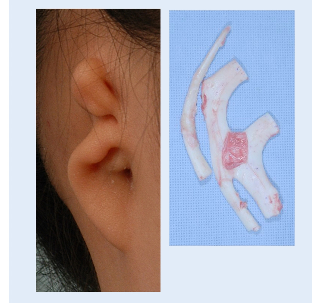 Year Old Girl S Right Microtia Reconstructed Ear Surgery Korea