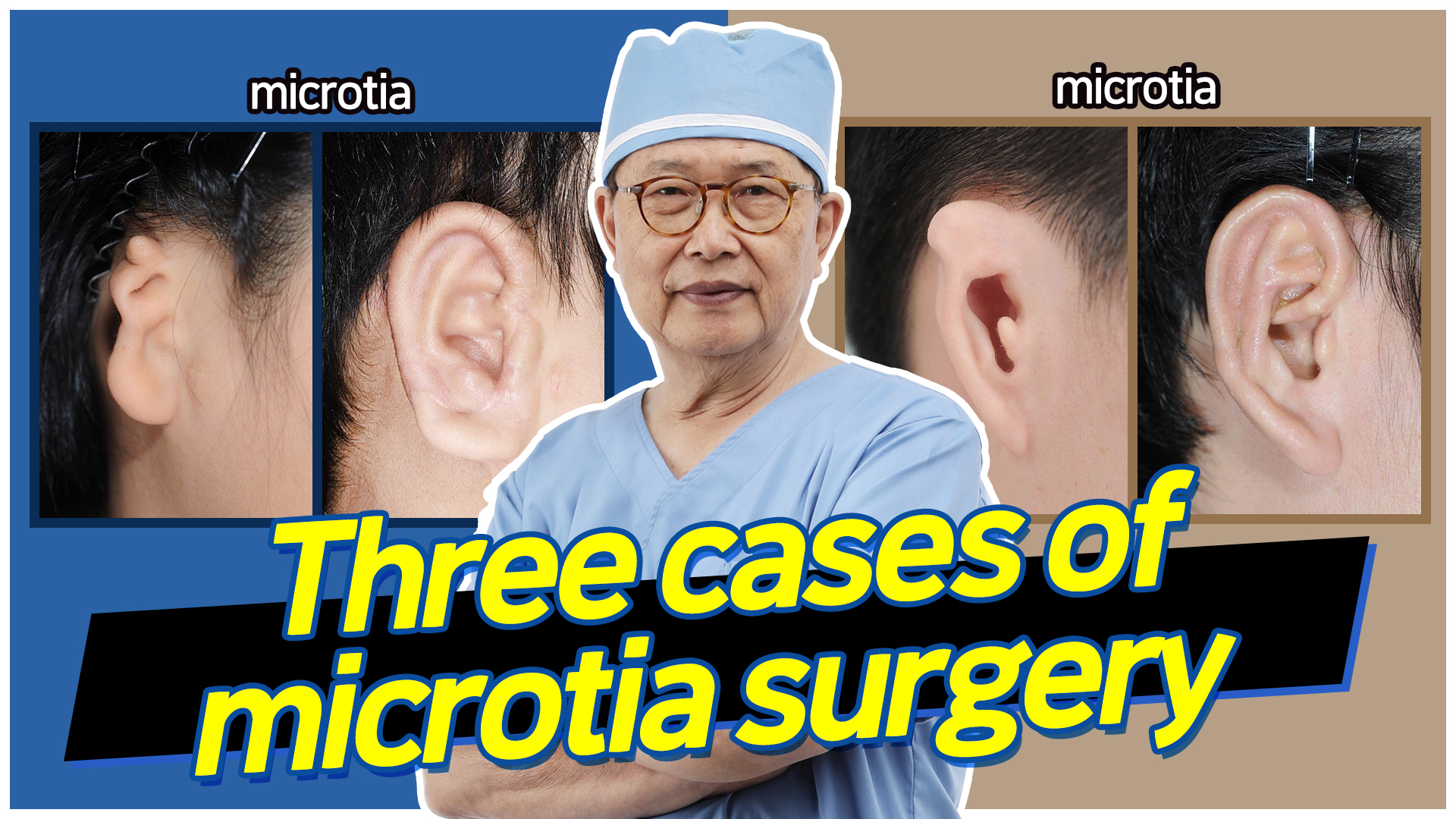 You are currently viewing Three cases of microtia surgery by Dr. Chul Park