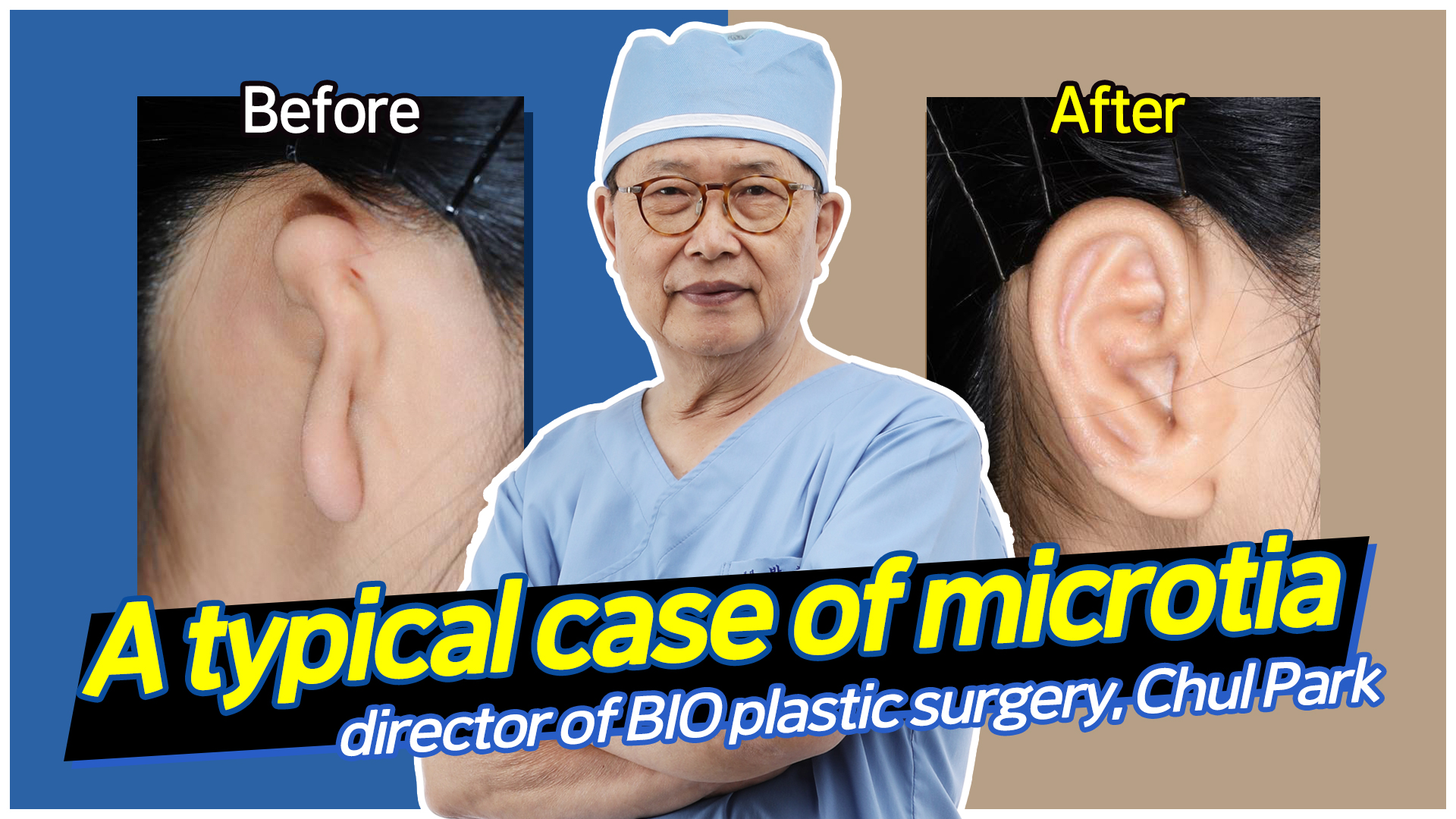 You are currently viewing A typical case of microtia, director of BIO plastic surgery, Chul Park