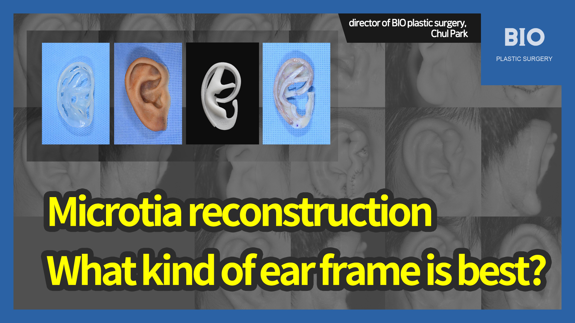 You are currently viewing Microtia reconstruction What kind of ear frame is best?