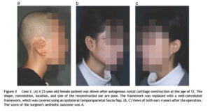 Read more about the article Total rebuilding of the ear after unsatisfactoryinitial microtia reconstruction: 30-yearexperience using autogenous costal cartilageframework [Chul Park]