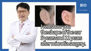 Read more about the article I will show you the shape of the ear 5 years and 11 years after microtia surgery.