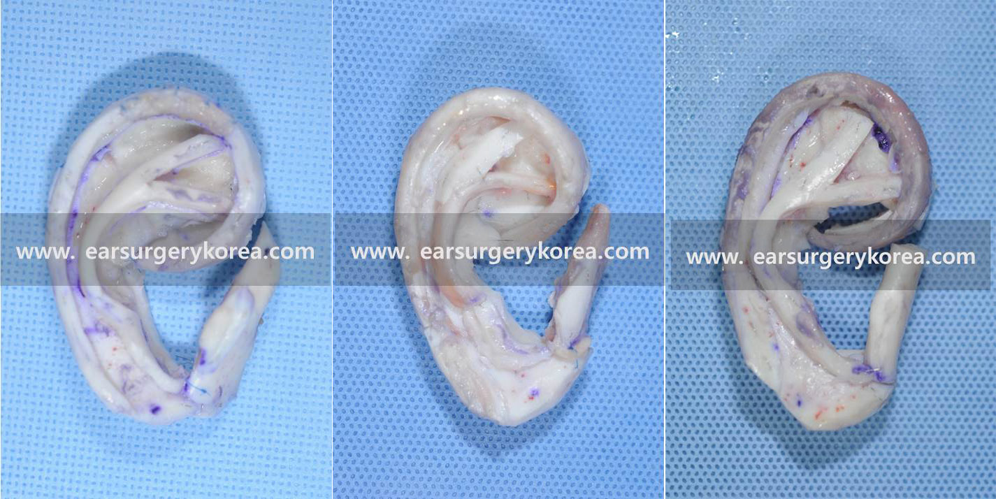 You are currently viewing microtia frame Medpore , rib cartilage for the framework of ear