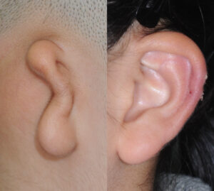 11-year-old girl's right microtia