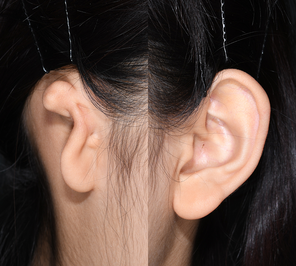 12-year-old girl presenting with right-sided microtia