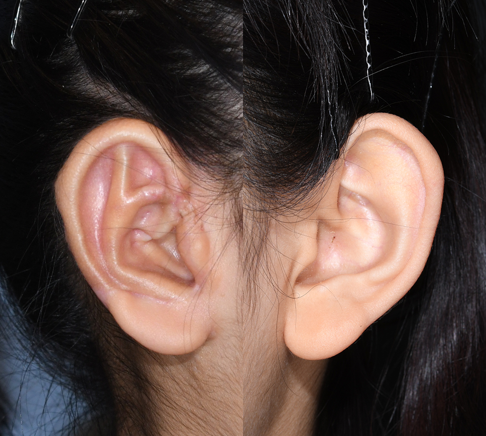 Ten years post-surgery, the reconstructed right ear